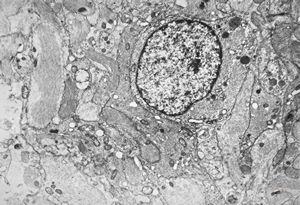 M,11y. | fibrillary astrocytoma M,11y. | fibrillary astrocytoma